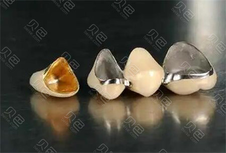 贵金属假牙(贵金属假牙 钛 迁移)