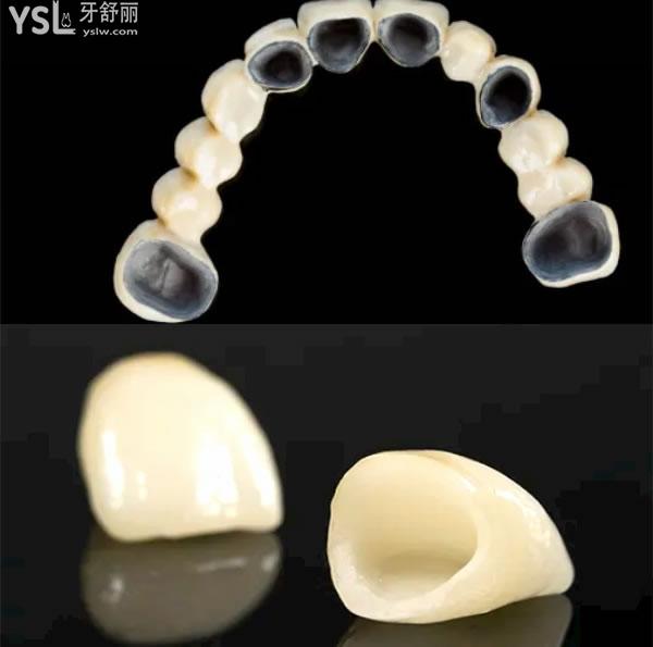 贵金属烤瓷牙多少钱一颗(贵金属烤瓷牙多少钱一颗?)