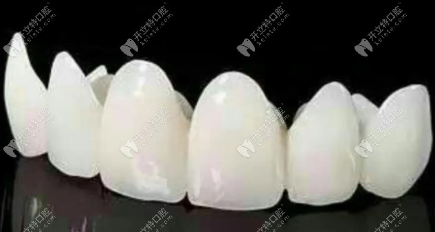 贵金属烤瓷牙多少钱一颗(贵金属烤瓷牙和非贵金属烤瓷牙的区别)