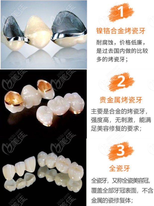 烤瓷牙贵金属(烤瓷牙贵金属和普通金属怎么看)
