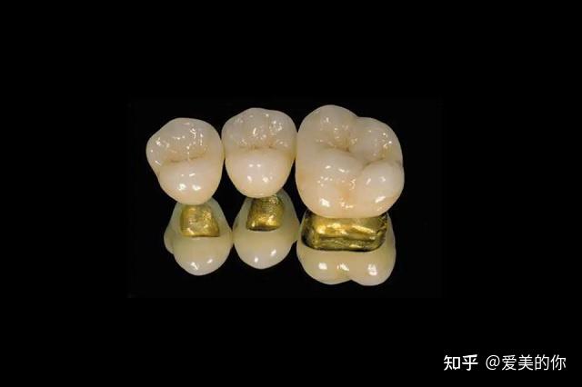 贵金属烤瓷牙(贵金属烤瓷牙多少钱)