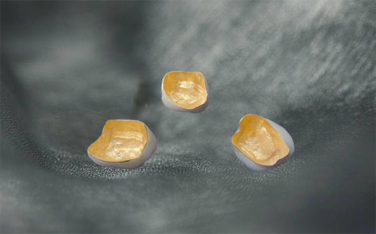 贵金属烤瓷牙(贵金属烤瓷牙多少钱)