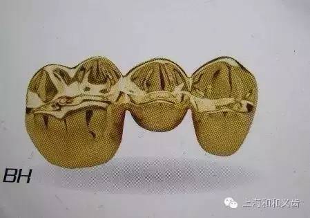 贵金属牙(贵金属牙冠)