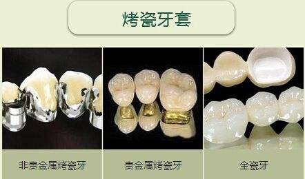 贵金属瓷牙(贵金属瓷牙不影响核磁共振吧)